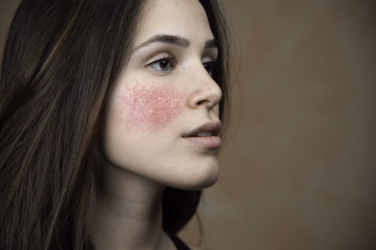 Jakiego makijażu mogę używać, jeśli mam trądzik różowaty?