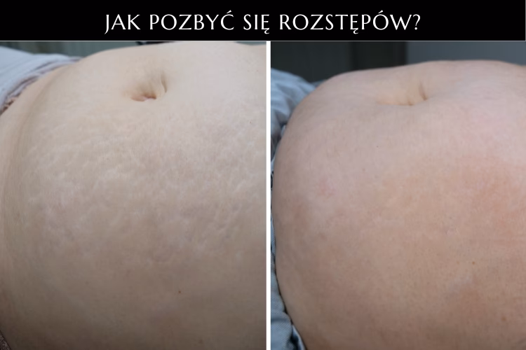 Czym można zakryć rozstępy?