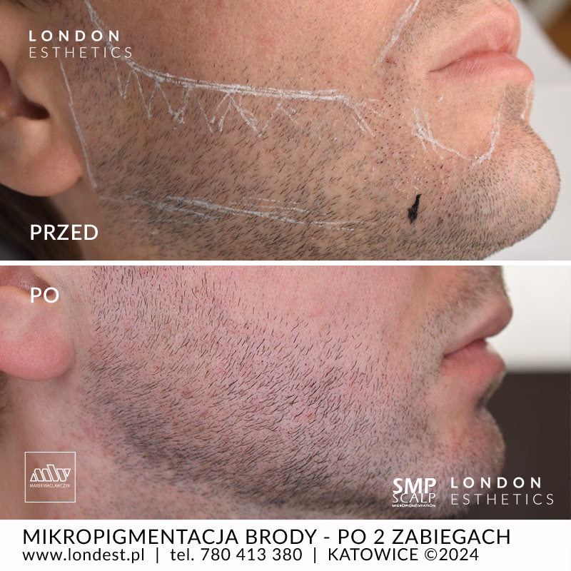 Na czym polega pigmentacja brody?