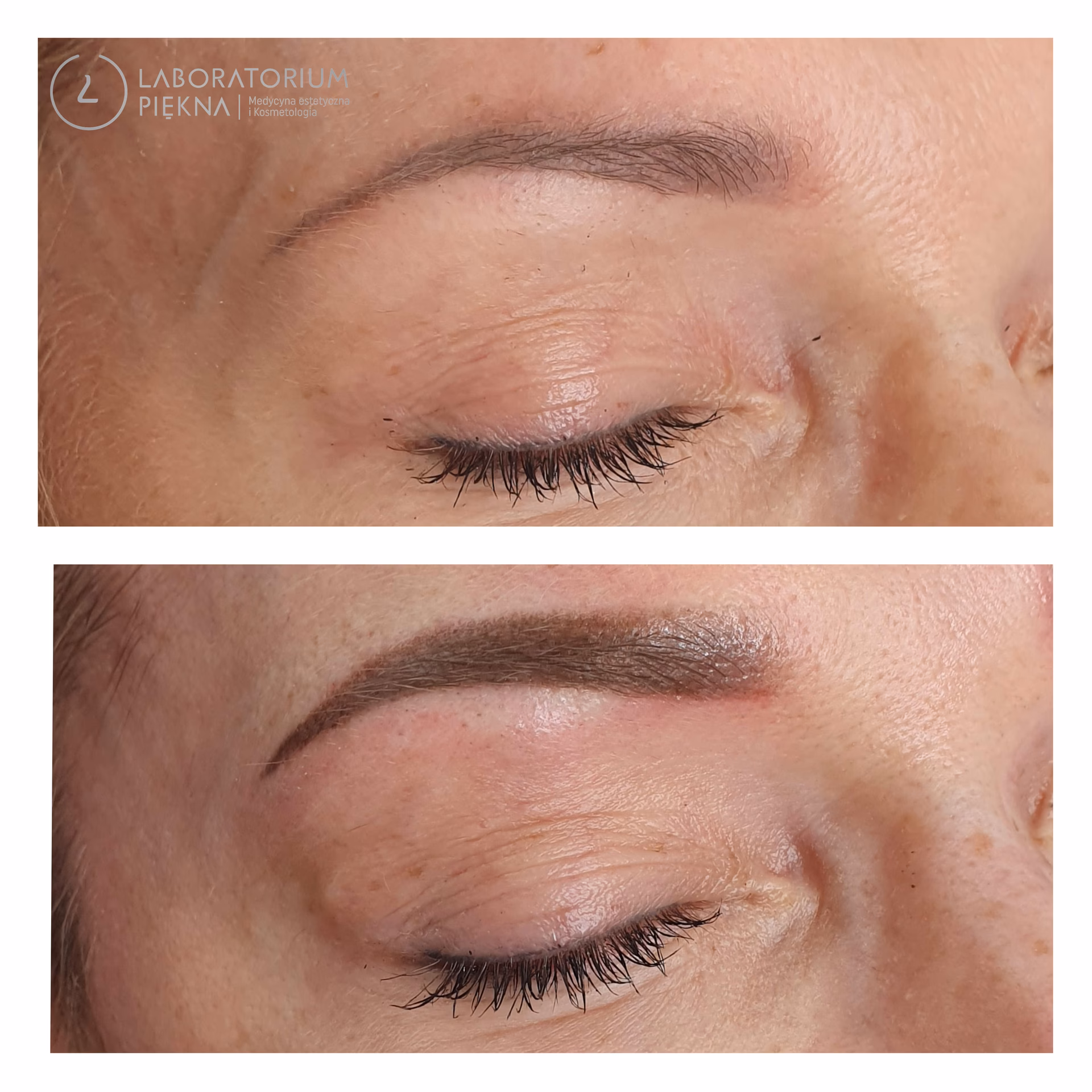 Czy mogę poddać się zabiegowi microbladingu, jeśli mam łuszczycę?