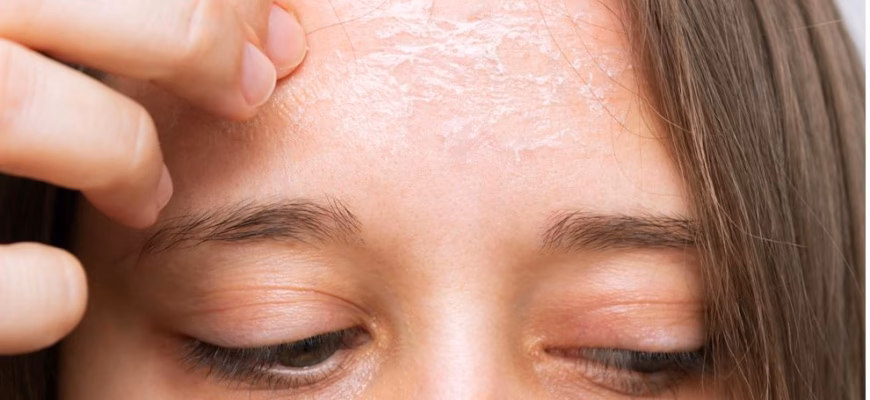 Czy można robić brwi permanentne przy łuszczycy?