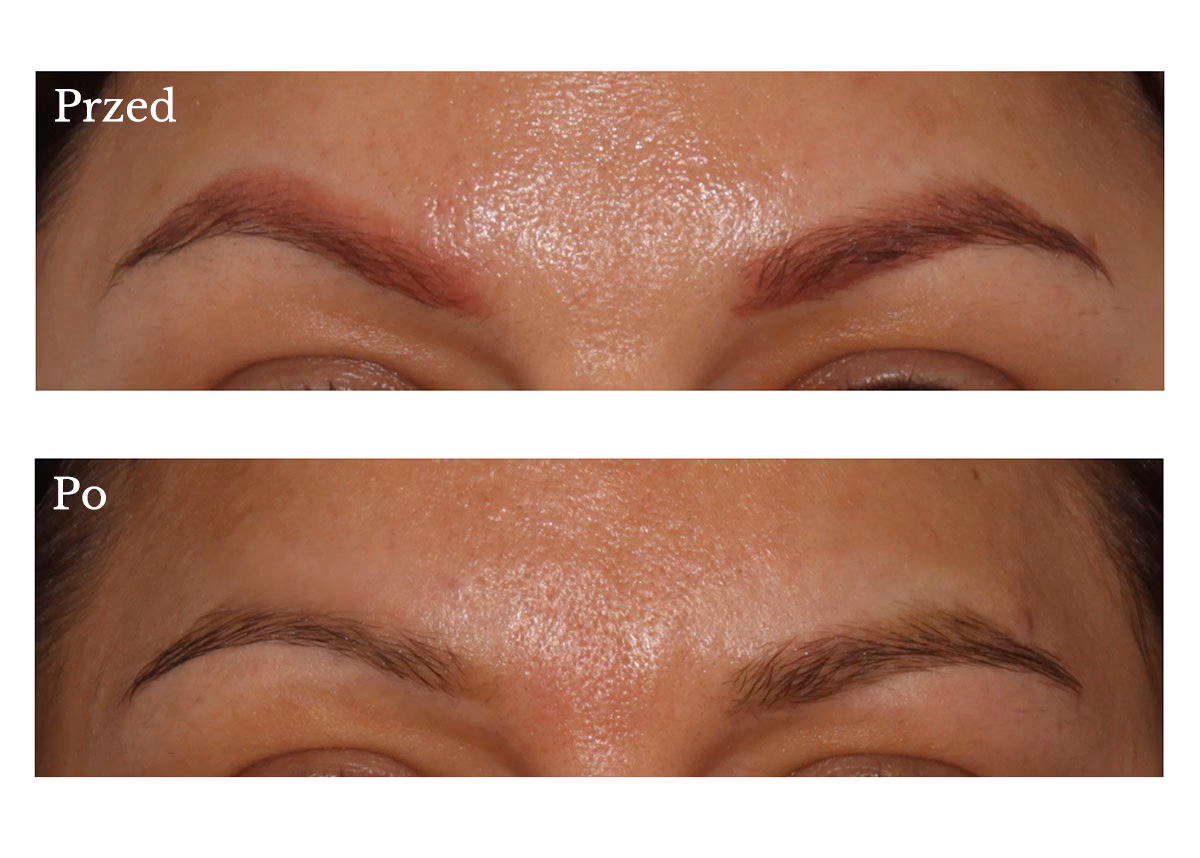 Jak przyspieszyć znikanie makijażu permanentnego?