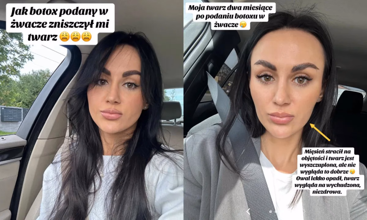 Ile po botoksie nie wolno się schylać?