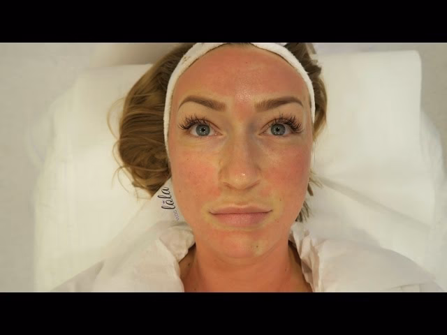 Czy po dermapenie można się malować?