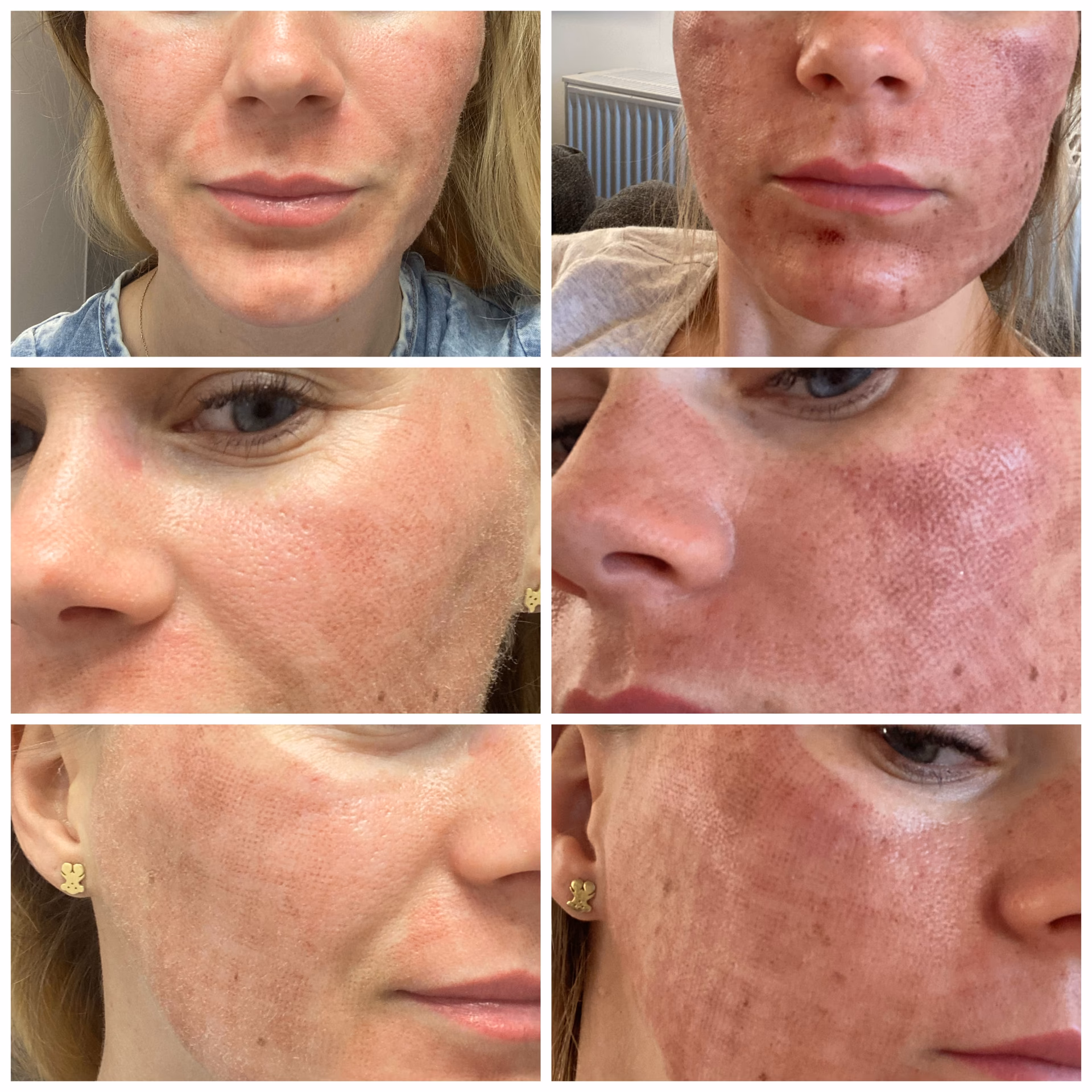 Kiedy można zrobić makijaż po laserze frakcyjnym?