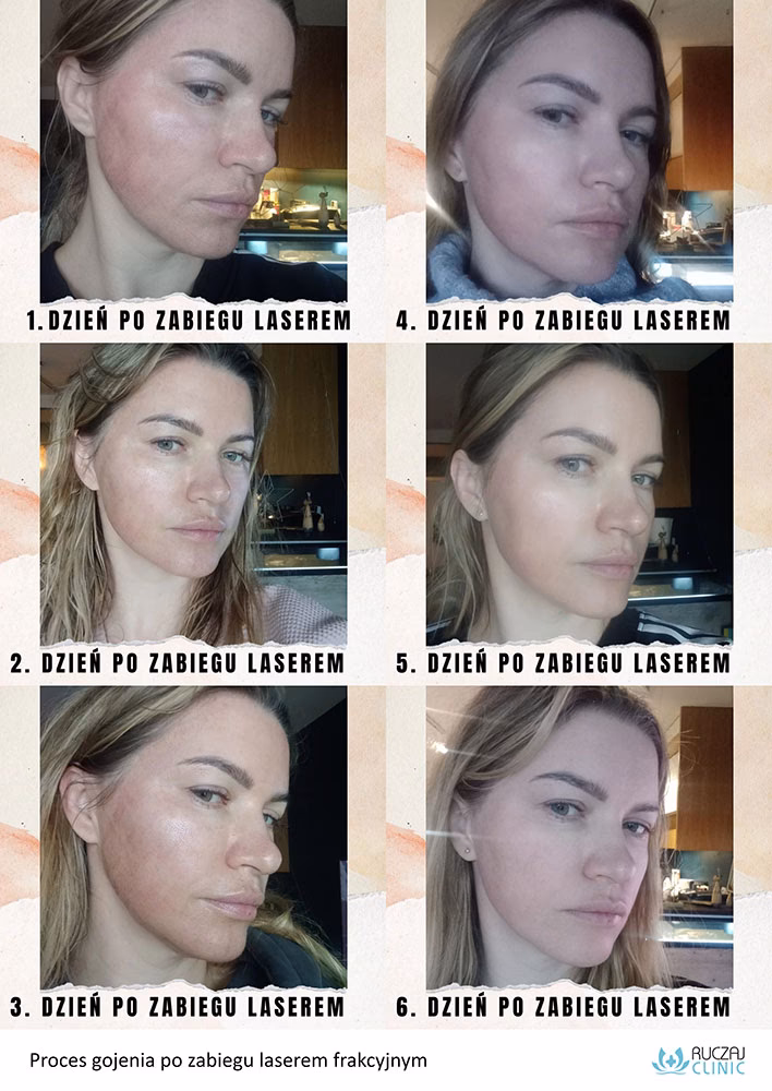 Kiedy można zrobić makijaż po laserze frakcyjnym?