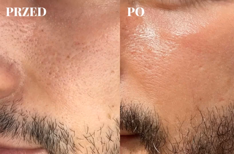 Ile po oczyszczaniu nie można się malować?