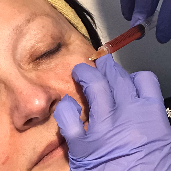 Ile utrzymuje się efekt po osoczu?