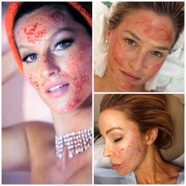 Ile kosztuje zabieg z osocza na twarz?