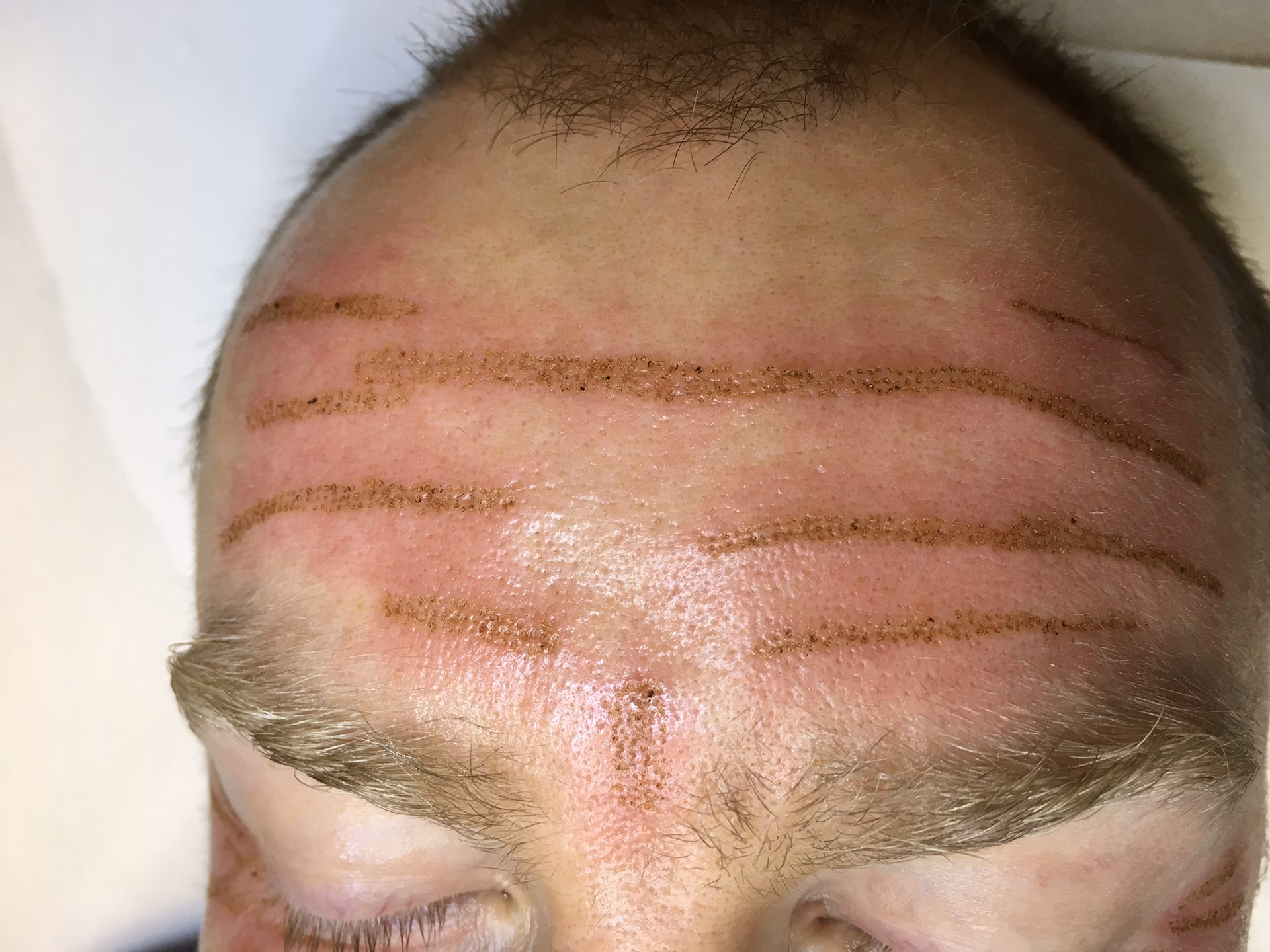 Ile kosztuje zabieg plazmy na twarz?