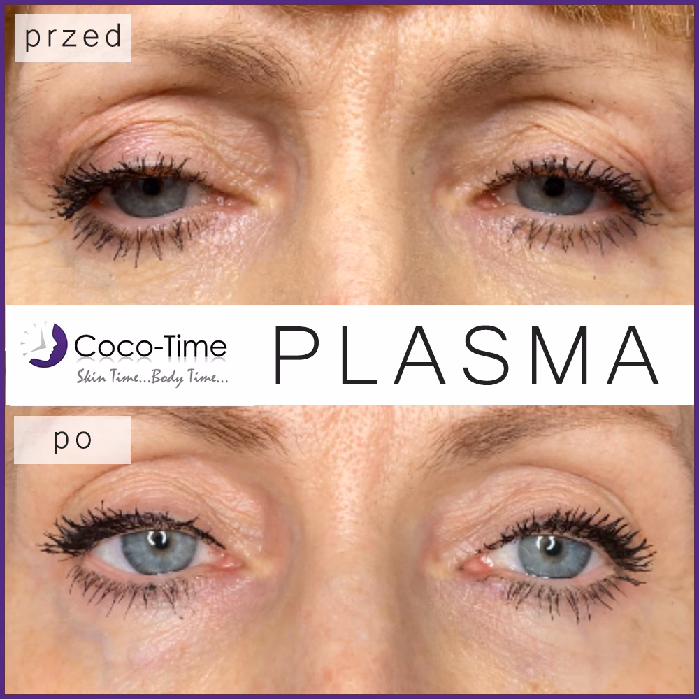 Czy plazma jest skuteczna?