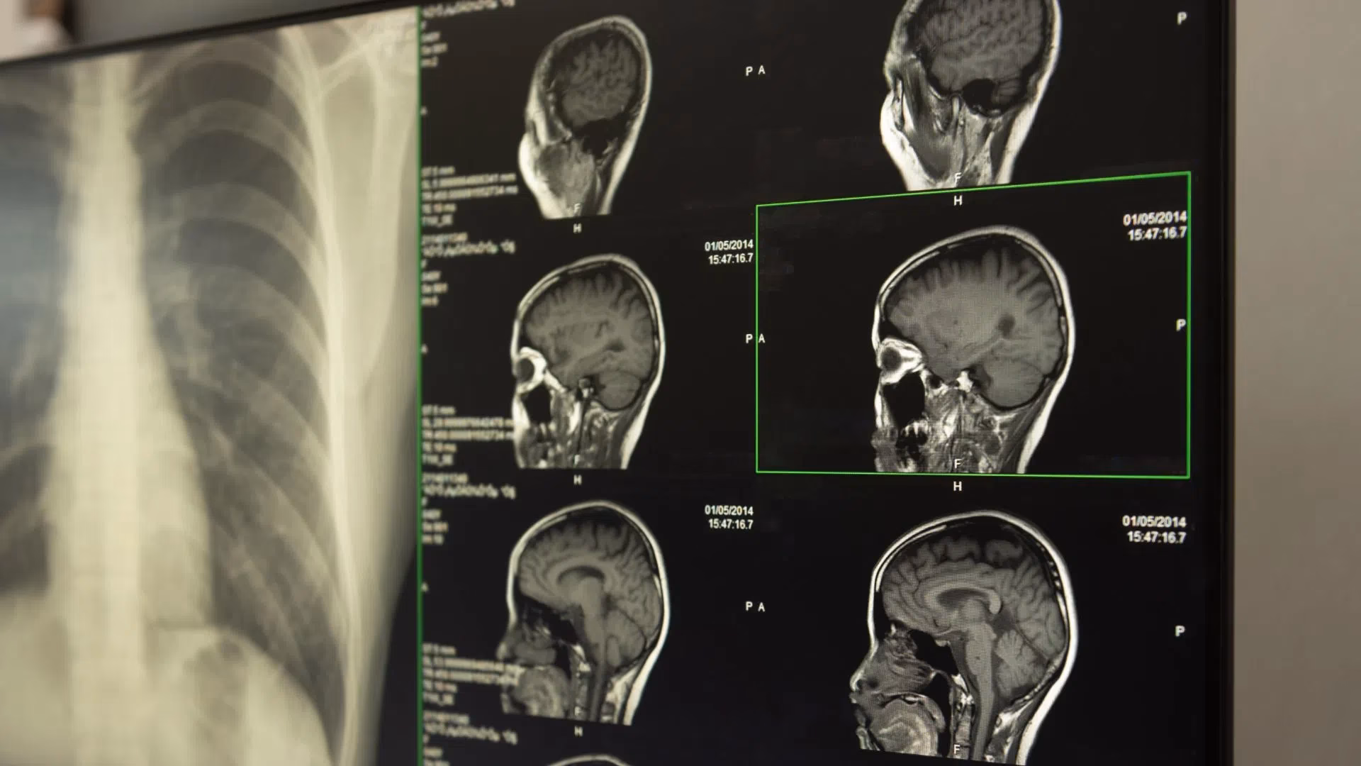 Czego nie robić przed tomografia głowy?