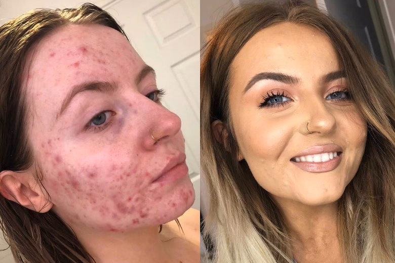 Czy podkład pogarsza trądzik?