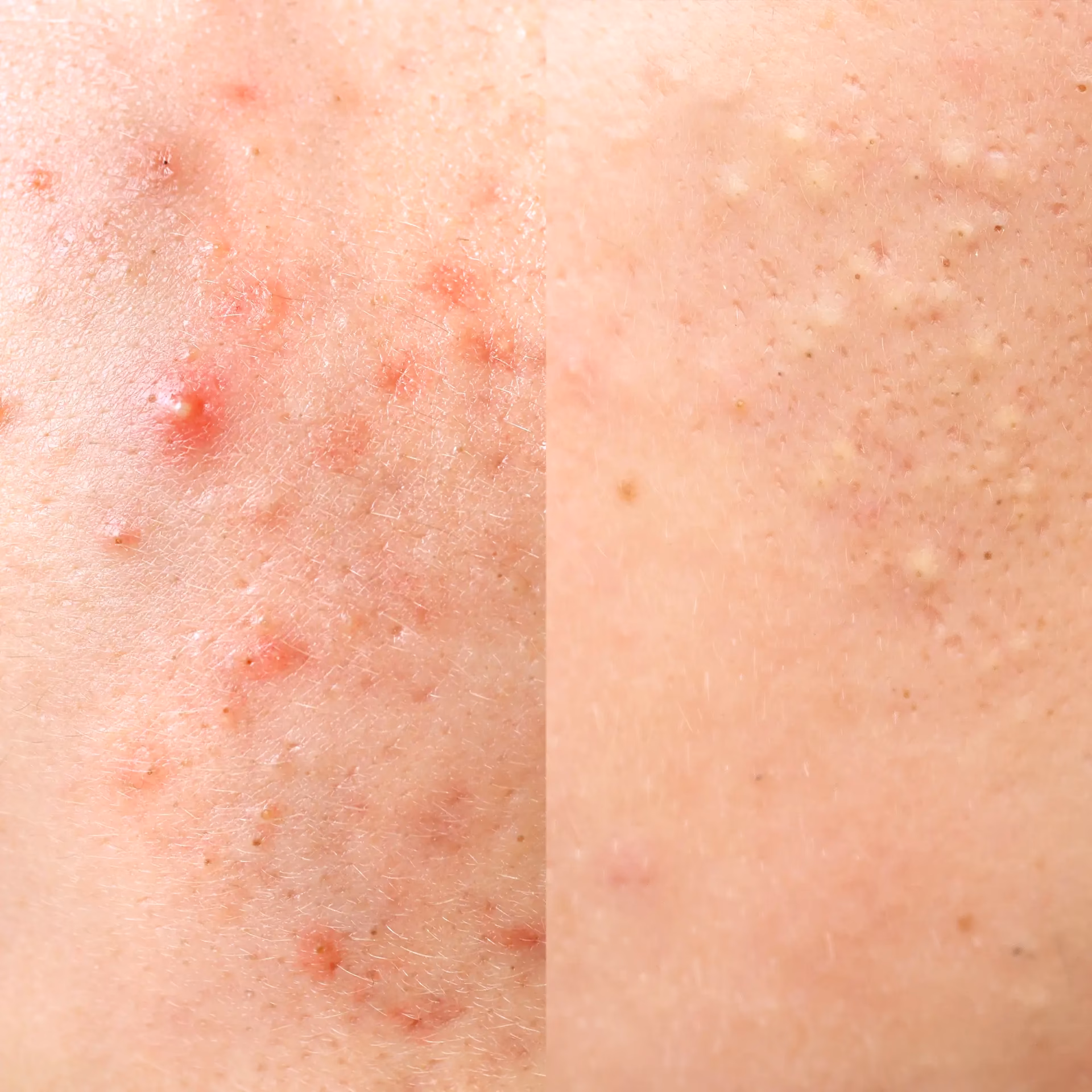 Jak długo trwa gojenie się trądziku kosmetycznego?