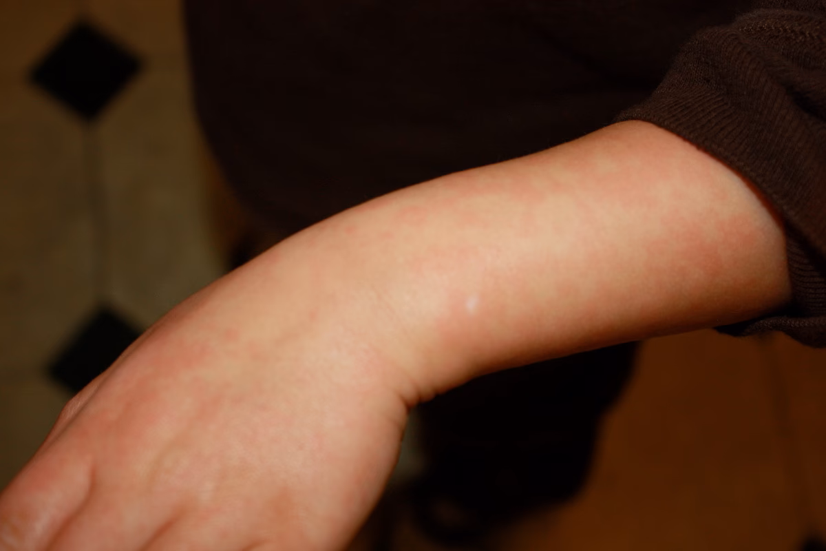 Jak pozbyć się reakcji alergicznej na woskowanie?