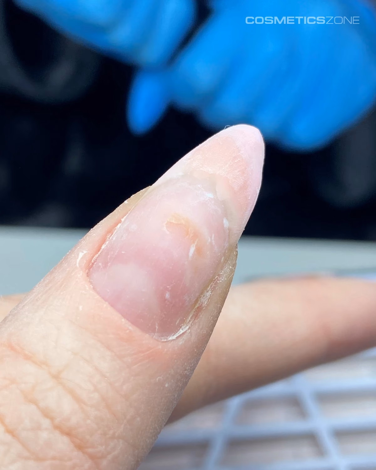 Jak pozbyć się reakcji alergicznej na woskowanie?