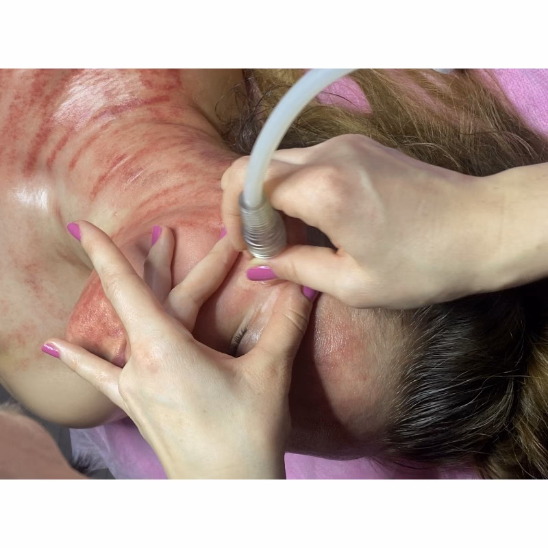 Na czym polega zabieg Vacuum na twarz?