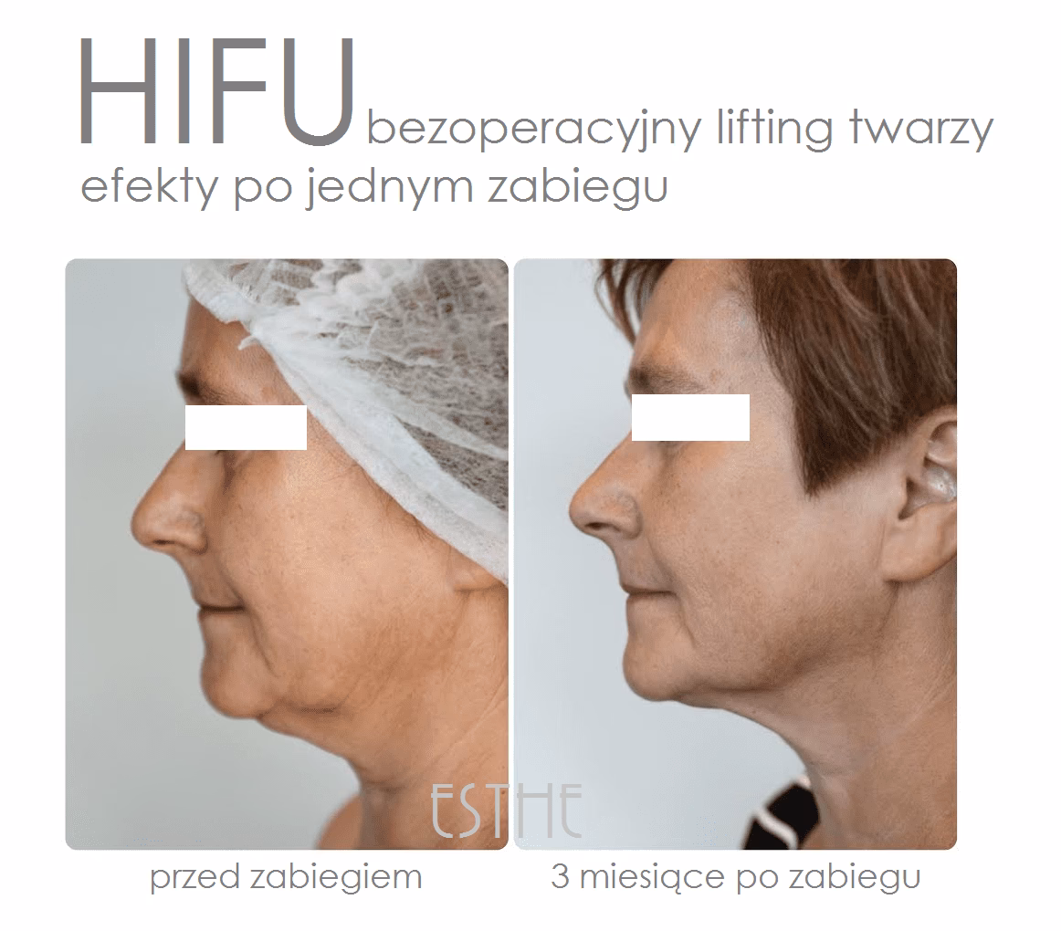 Czy HIFU wygląda zmarszczki?